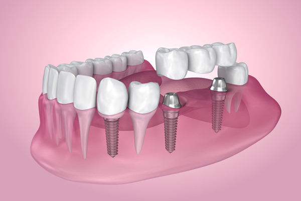 3D rendering of mouth with multiple dental implants at Karl Hoffman Dentistry in Lacey, WA