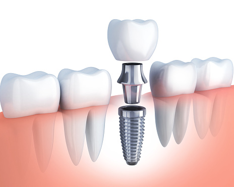 Single tooth implant in row of teeth at Karl Hoffman Dentistry in Lacey, WA