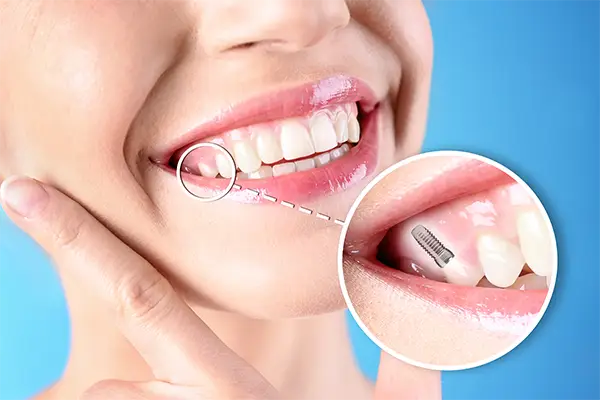 Smiling woman pointing to her teeth with an inset showing a close up view of a dental implant set in the jaw.